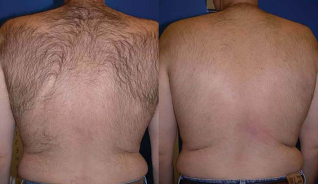Back Hair Removal