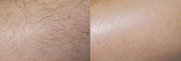 Laser Hair Removal