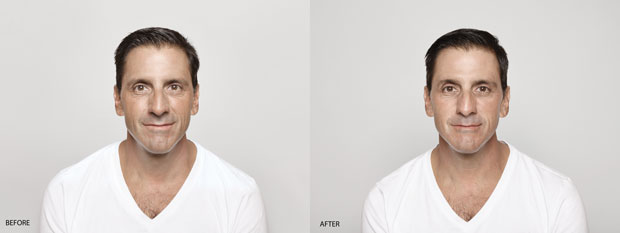 Sculptra - Before and After