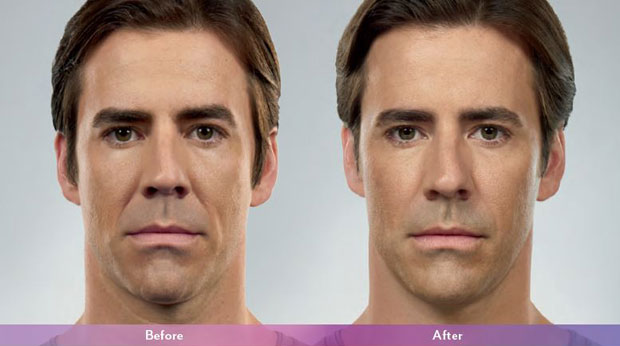 Dermal Fillers Treatment