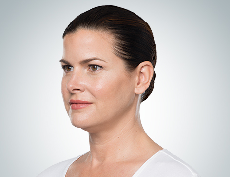 Some Amazing “Before and After” Pictures of Kybella Users