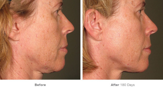 Ultherapy Before & After