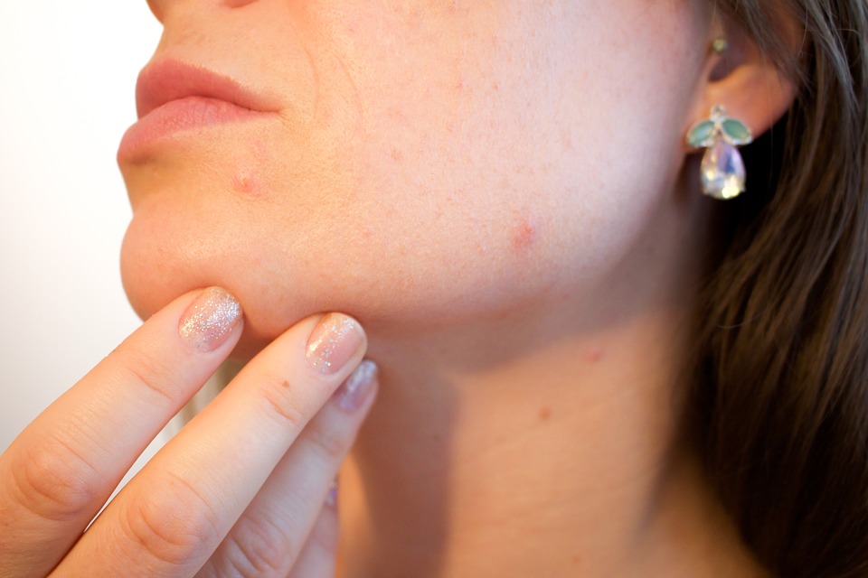 The Best Treatments for Acne Scars