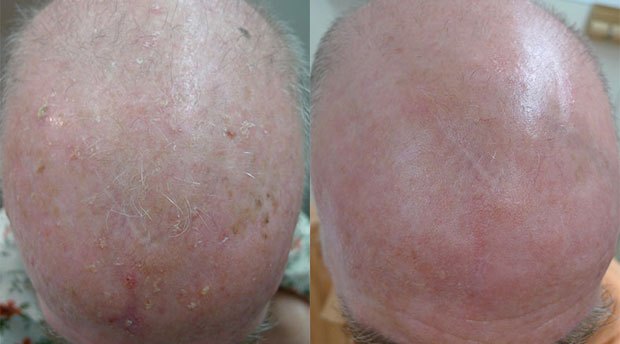 3 Ways to Get Rid of Rough/Irregular Skin