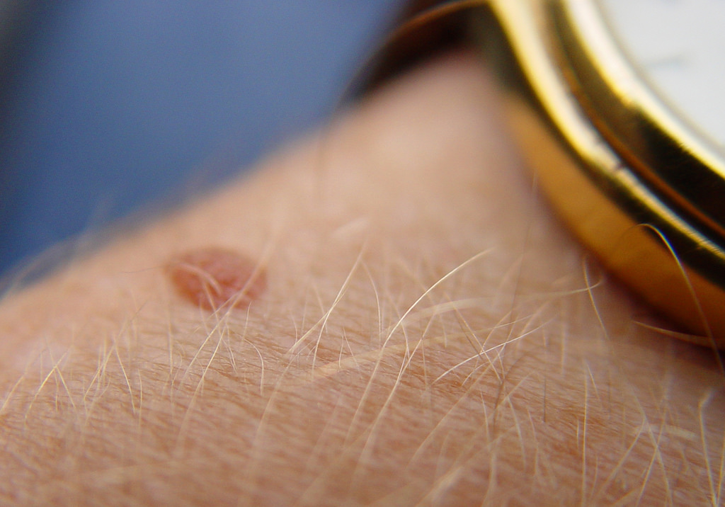 What Causes Moles? (And How You Can Get Rid of Them)