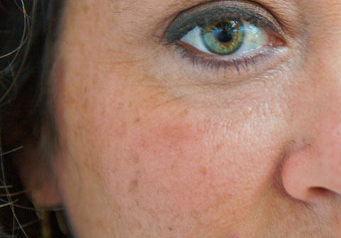 How Do Aesthetic Lasers Work?