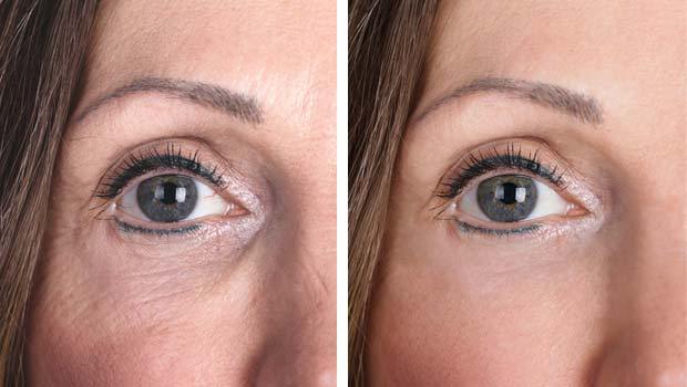 platelet-rich plasma