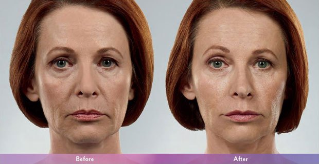 What Are Dermal Fillers and How Do They Work?
