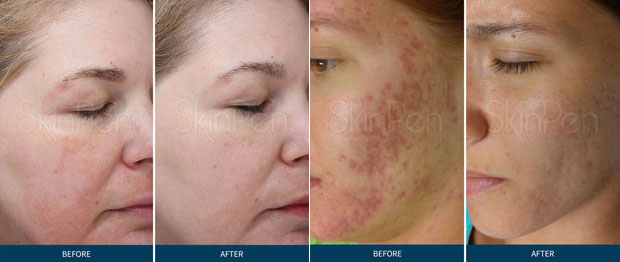 Microneedling Before and After