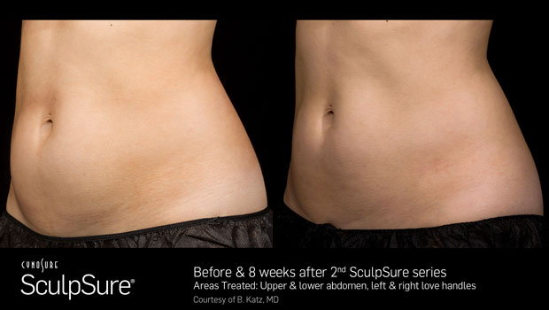 SculpSure Treatment
