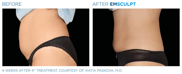 EMSculpt Treatment Results