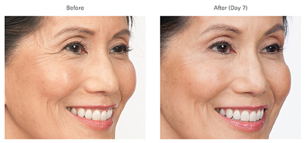 How Long Does Botox Last