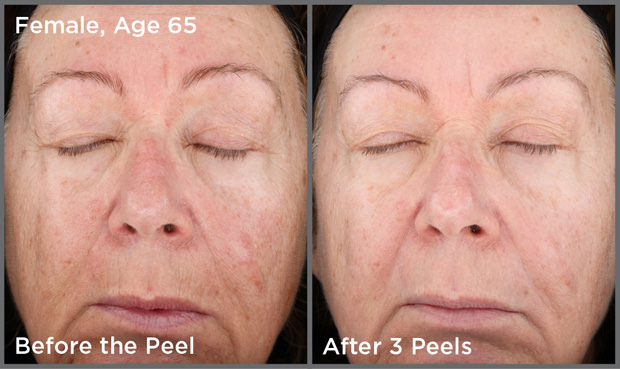 Chemical Peel Treatments