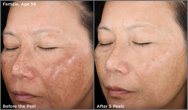 Chemical Peel