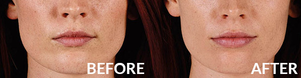 Lip Fillers Before & After