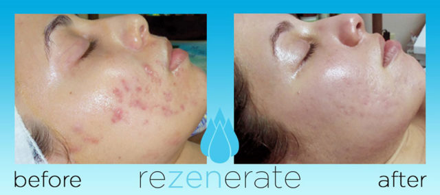 Rezenerate Nanofacial Before After