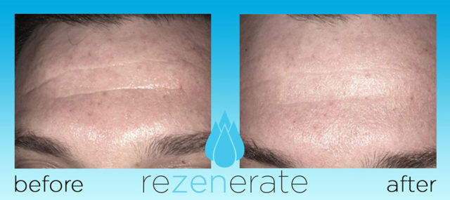 Rezenerate Nanofacial Before and After