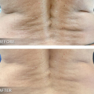 Exilis Ultra Back Treatment Before and After