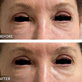 Exilis Ultra Eye Treatment Before and After