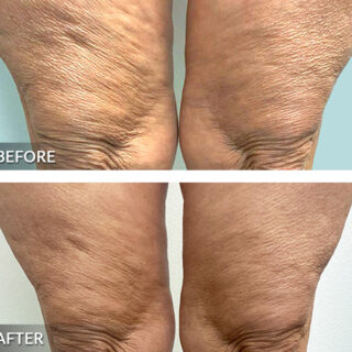 Exilis Ultra Leg Treatment Before and After