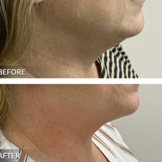 Exilis Ultra Neck Jawline Treatment Before and After