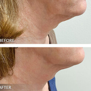 Exilis Ultra Neck Treatment Before and After