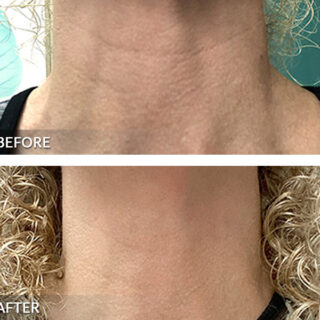 Exilis Ultra Neck Treatment Before and After