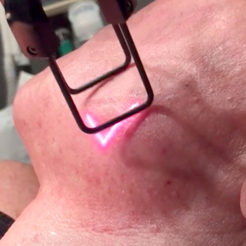 Fractionated CO2 Laser Facial Resurfacing