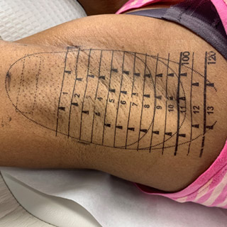 miraDry Hyperhidrosis Treatment