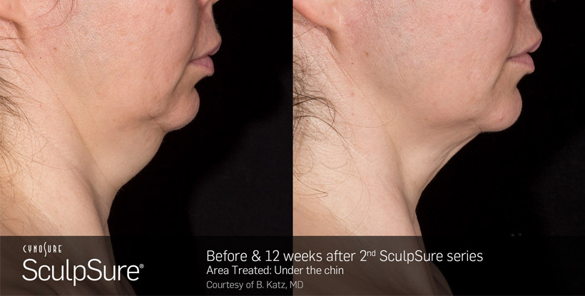 SculpSure Fat Reduction for Chins