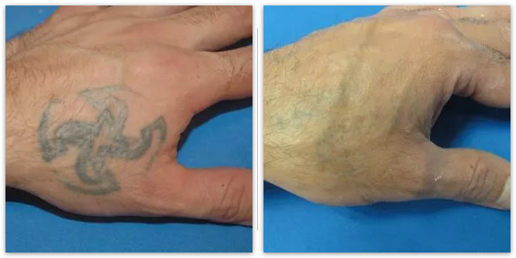 Laser Tattoo Removal Before / After
