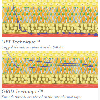 How PDO Thread Lift Works