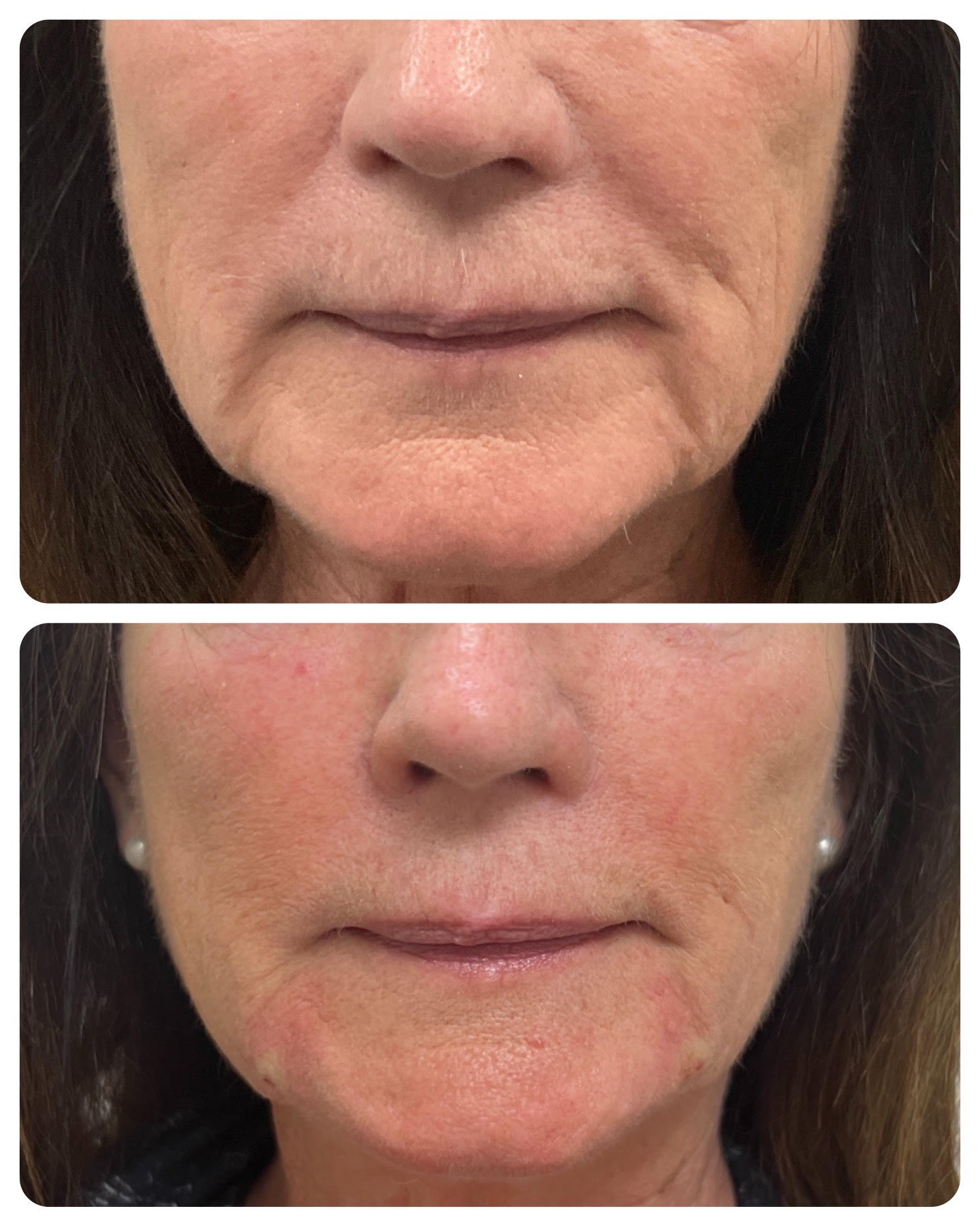 Before and after filler