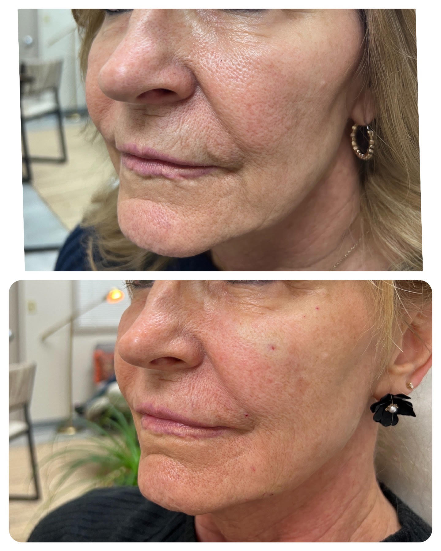 Before and after filler