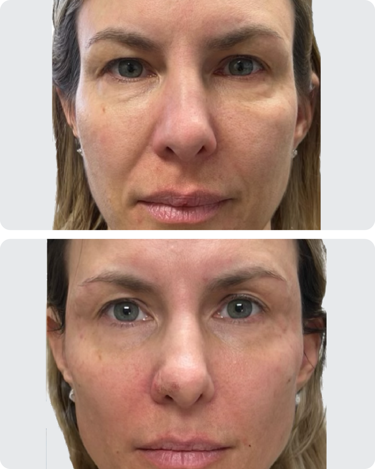 Before and After of Filler, Sculptra and Tox