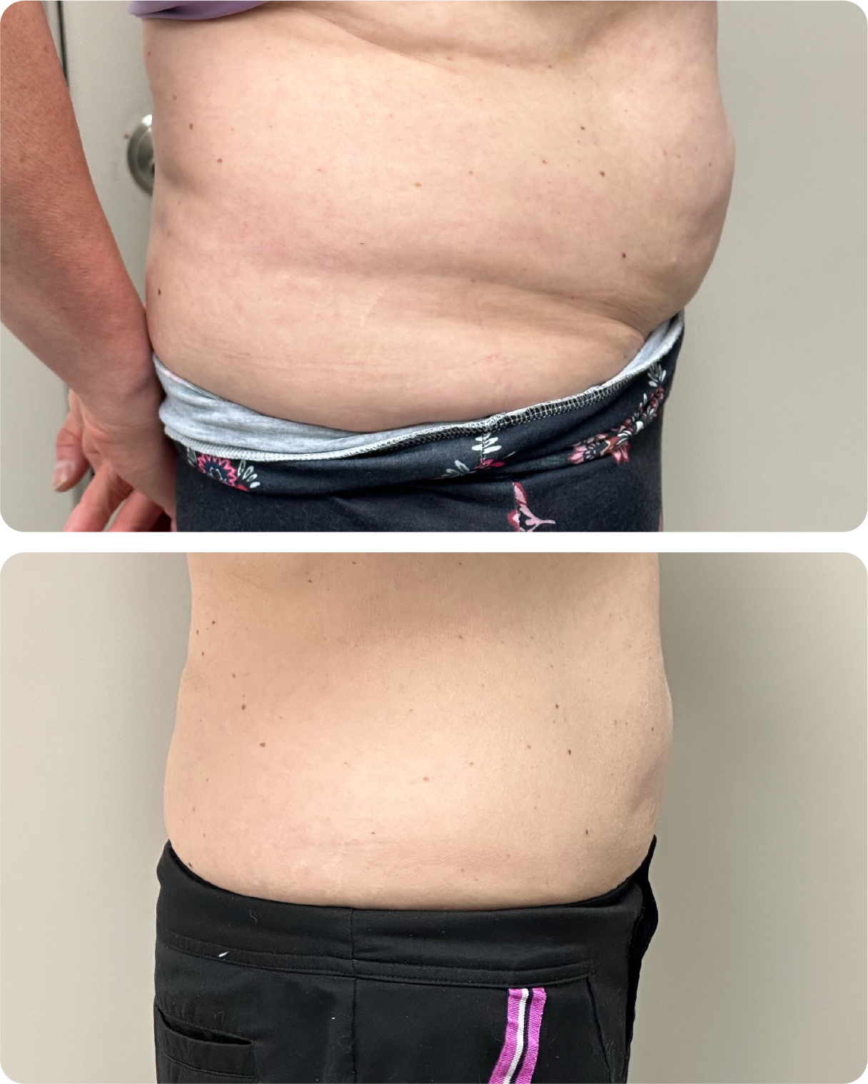 Before and After Using Semaglutide