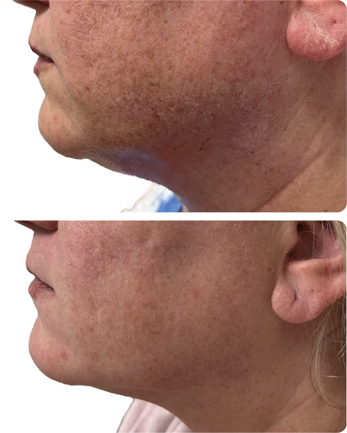 Before and after of a client getting morpheus8 at a medical aesthetic facility