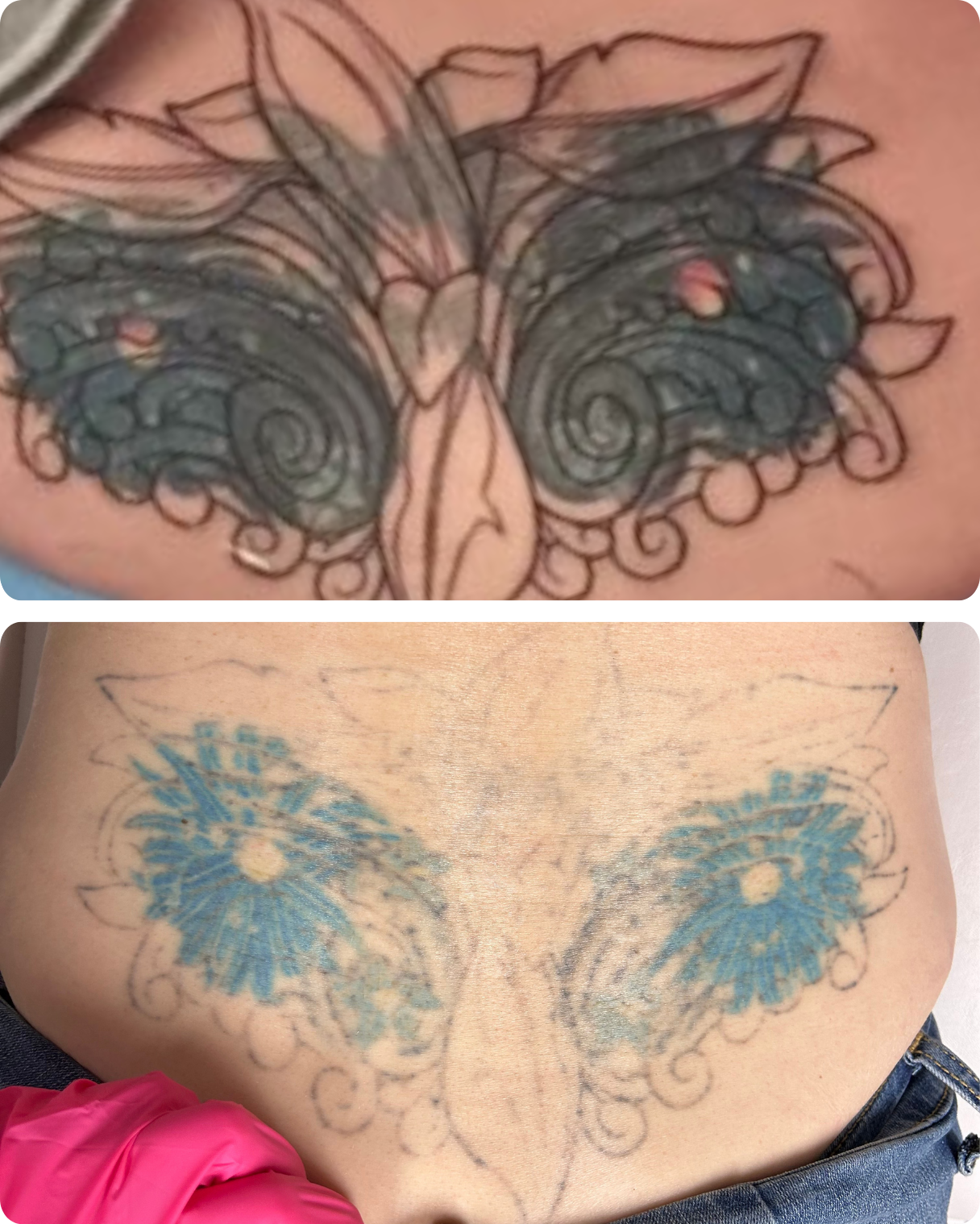 Before & After Alma Harmony Laser Tattoo Removal