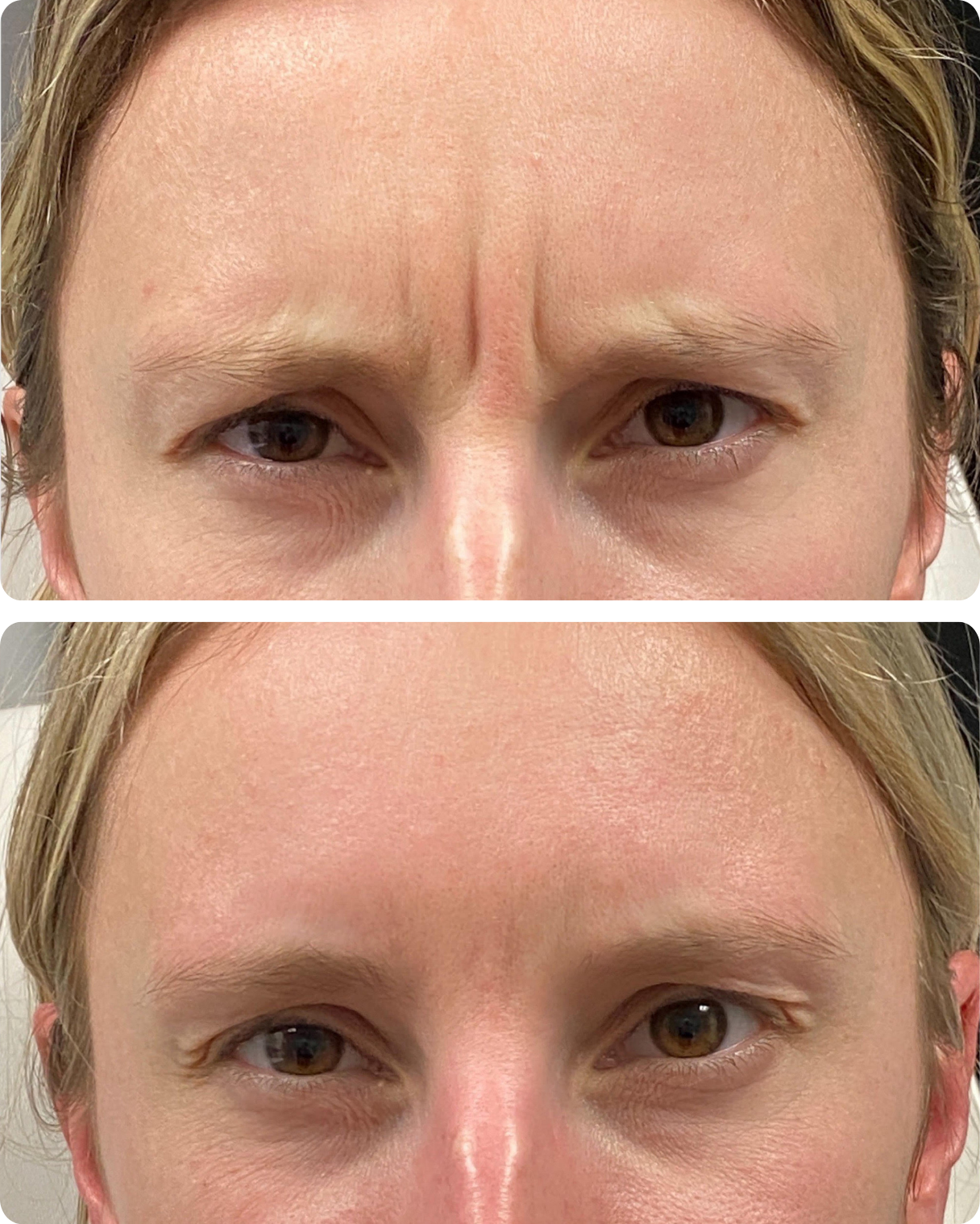 Before and after botox