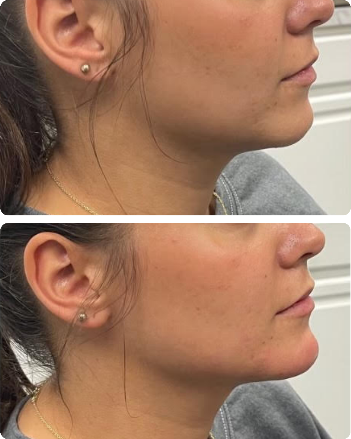 Before and after filler