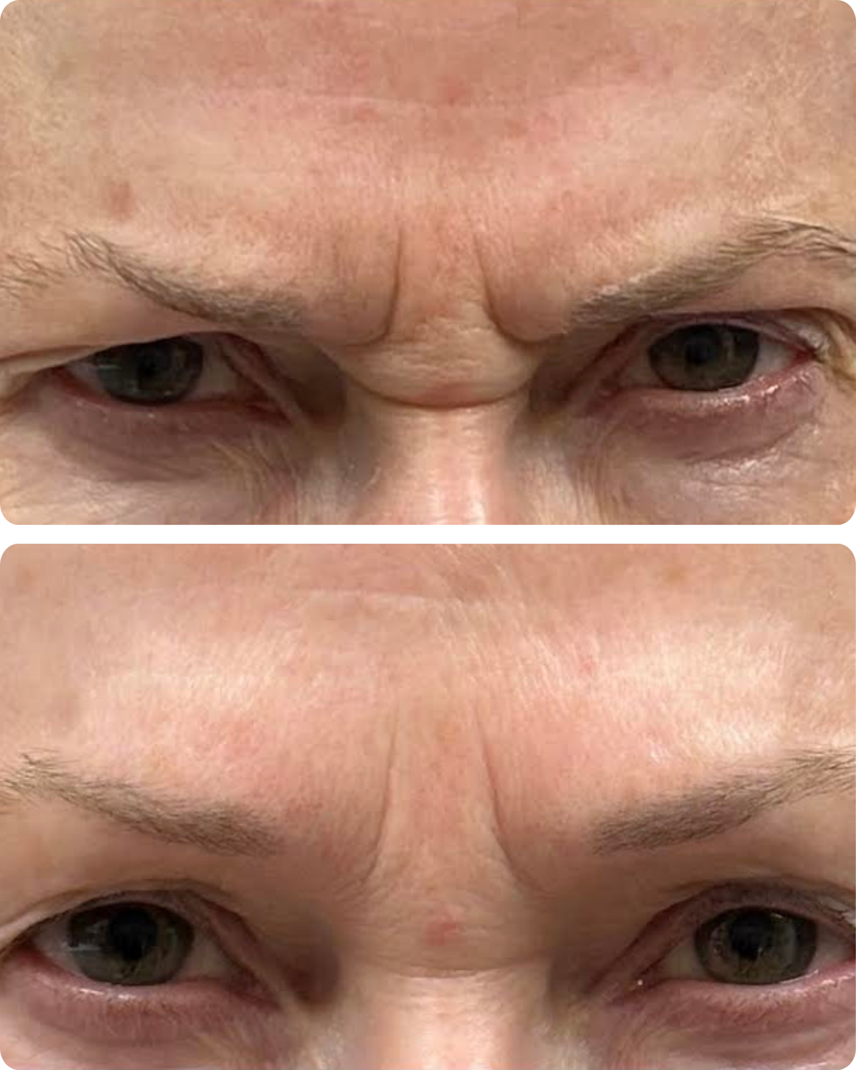 Before & After Daxxify