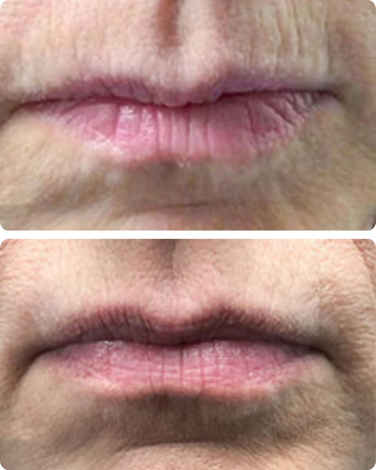 Before & After Exilis Ultra 360