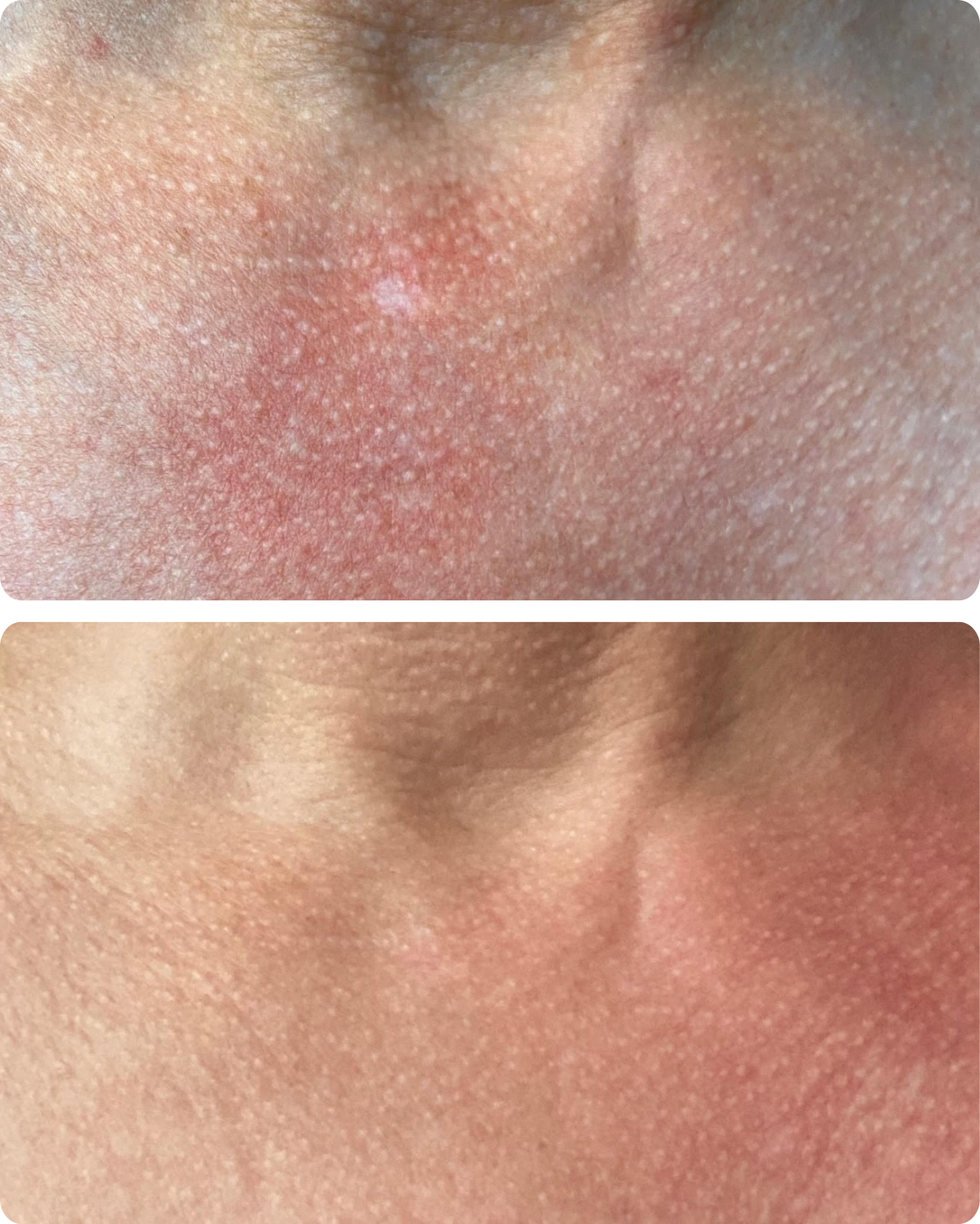 Before & After Excimer