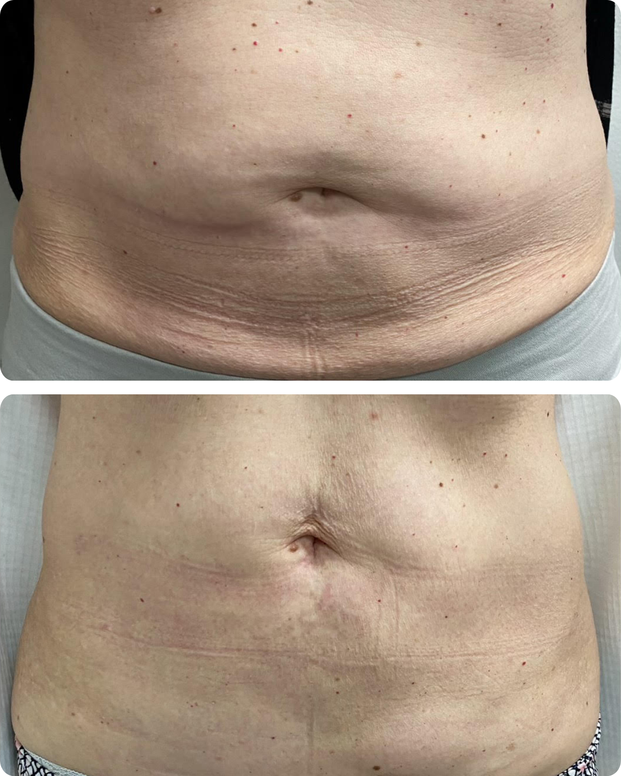 Before & After Exilis