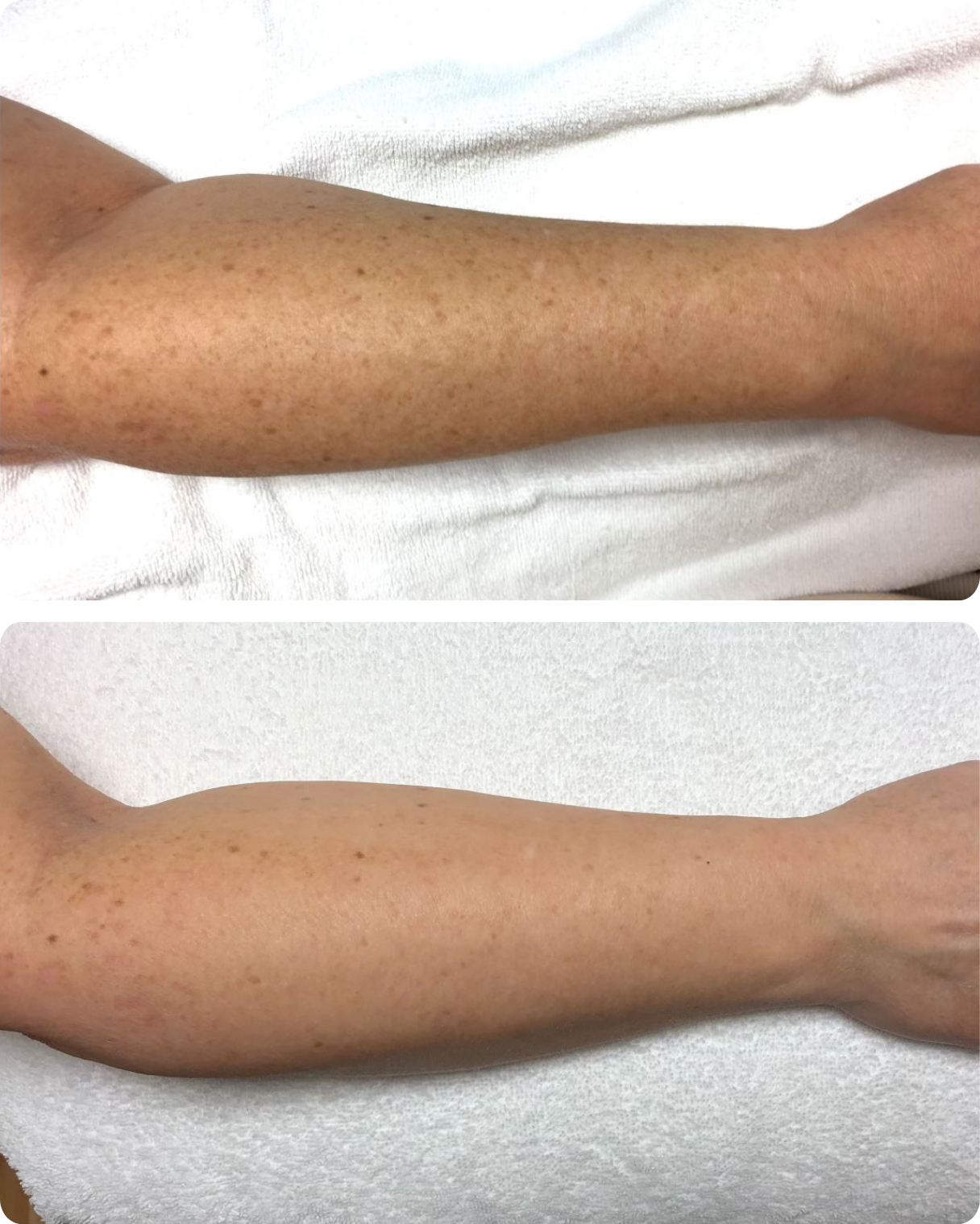 IPL treatment, or intense pulsed light therapy