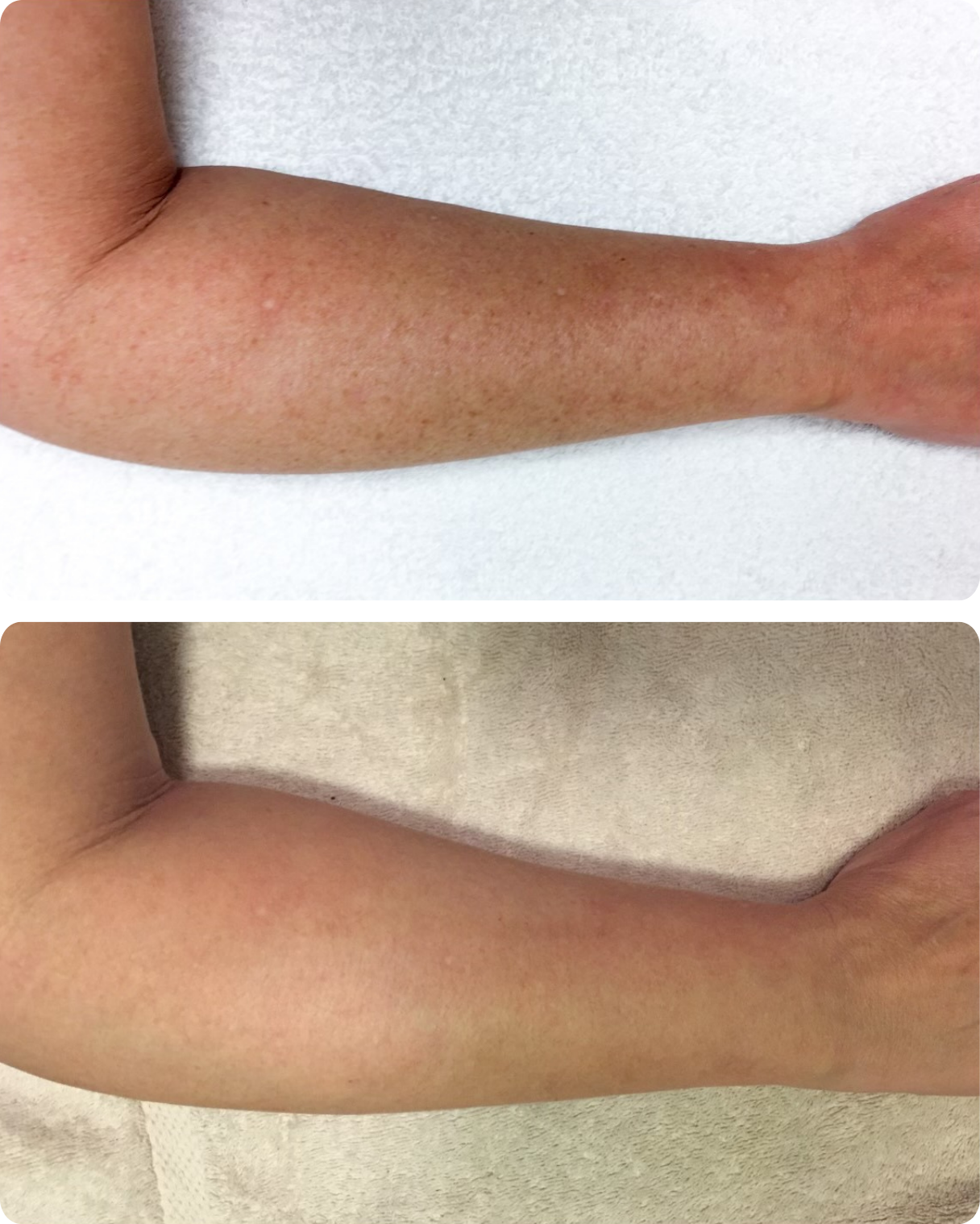 IPL treatment, or intense pulsed light therapy