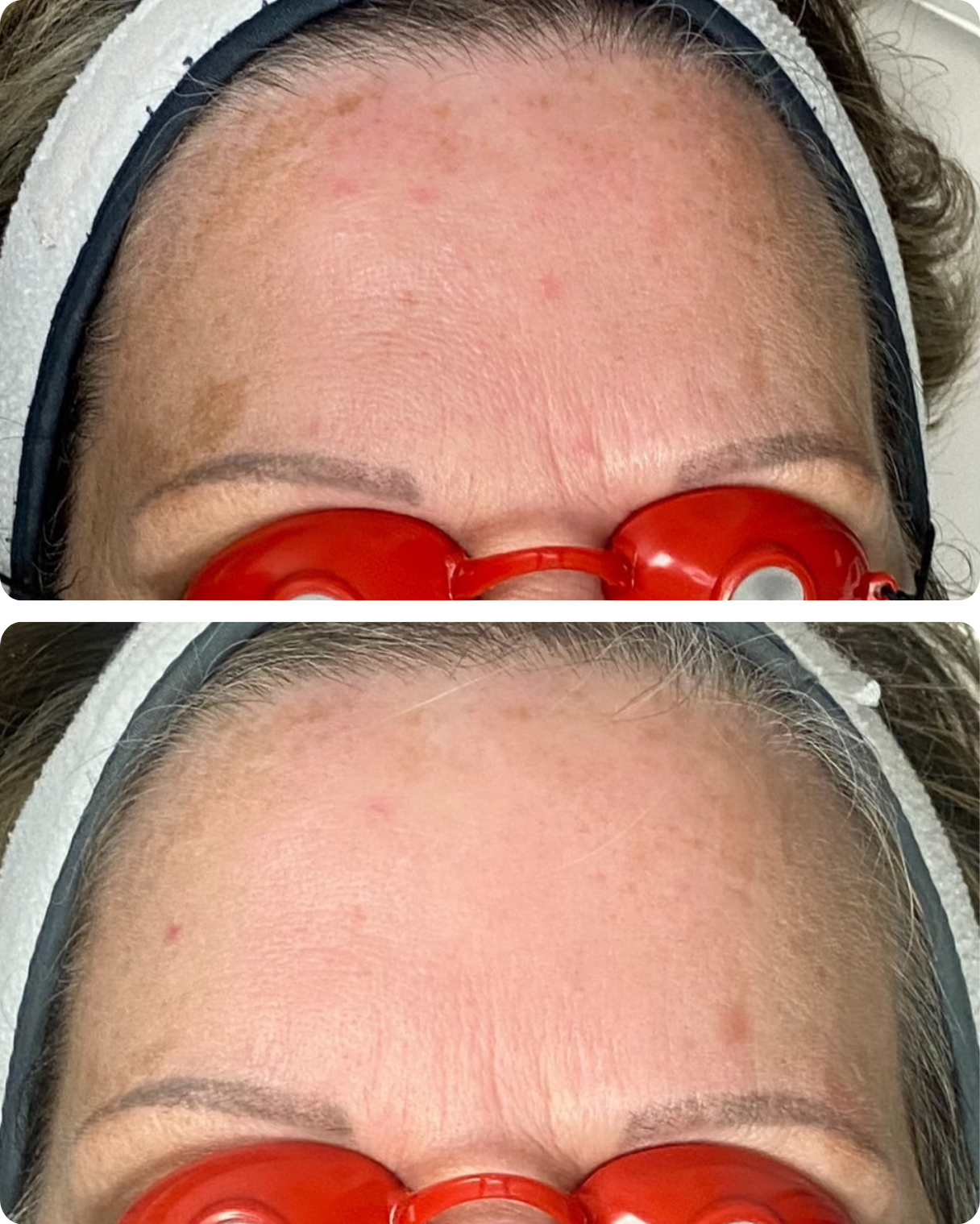 IPL treatment, or intense pulsed light therapy