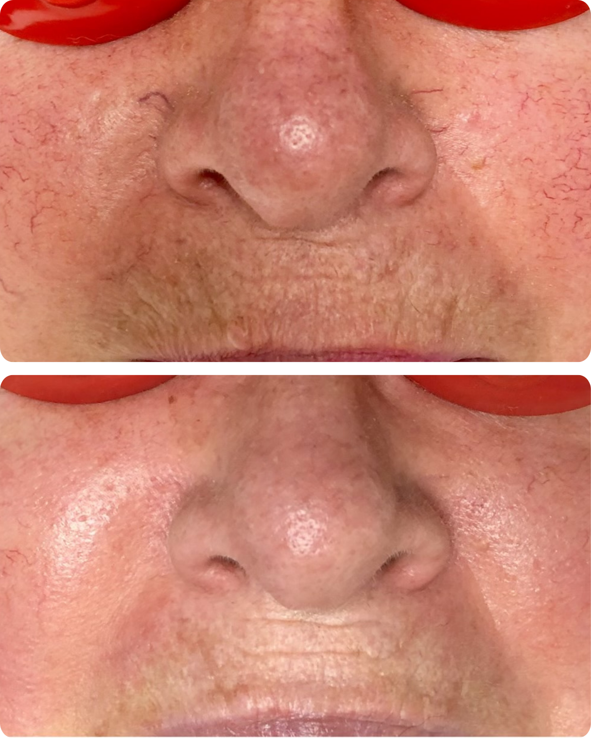 IPL treatment, or intense pulsed light therapy