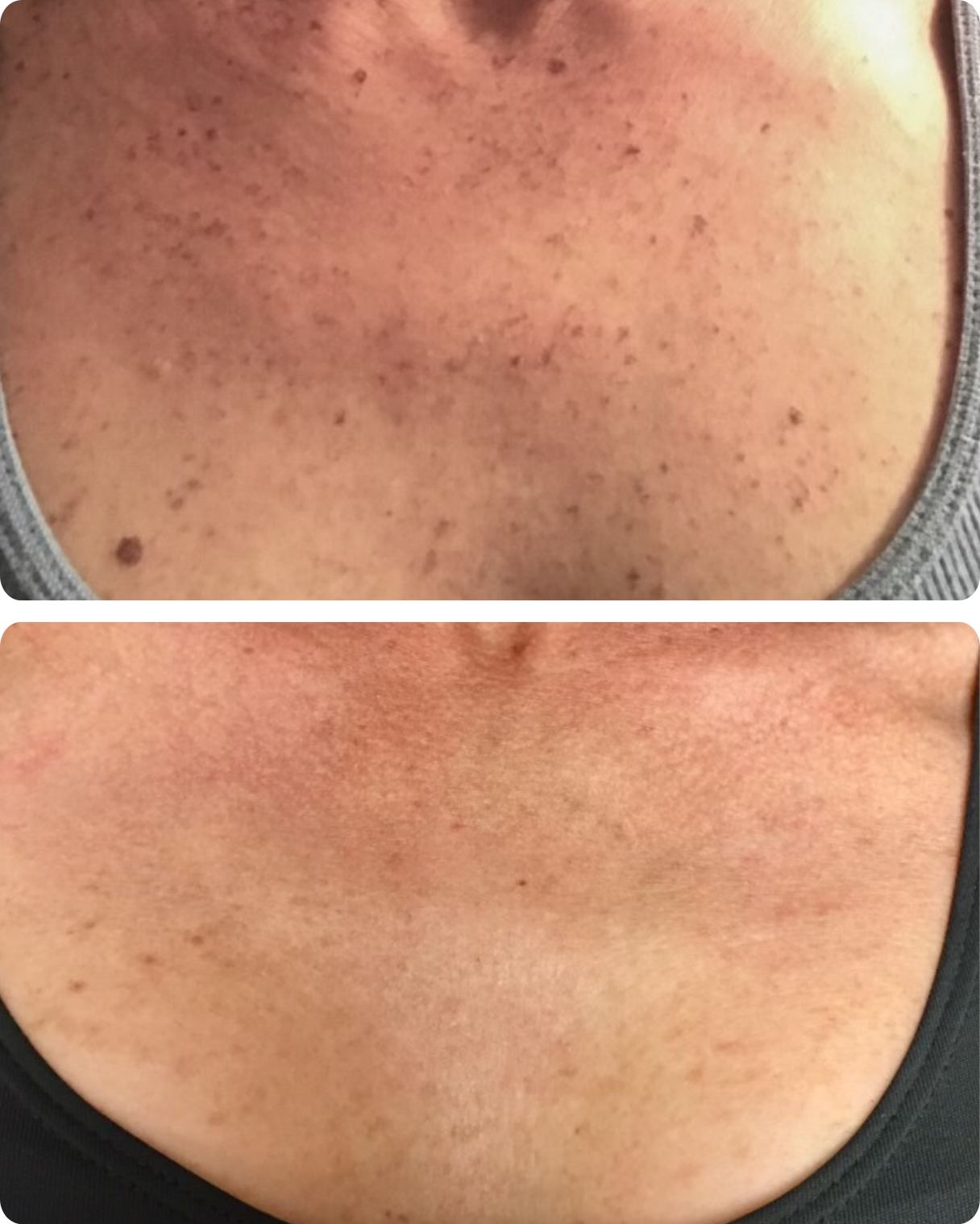 IPL treatment, or intense pulsed light therapy