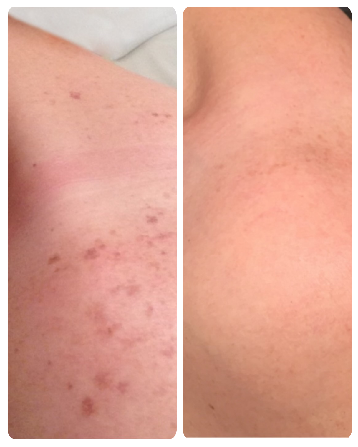 IPL treatment, or intense pulsed light therapy